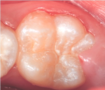 Dente irrompendo